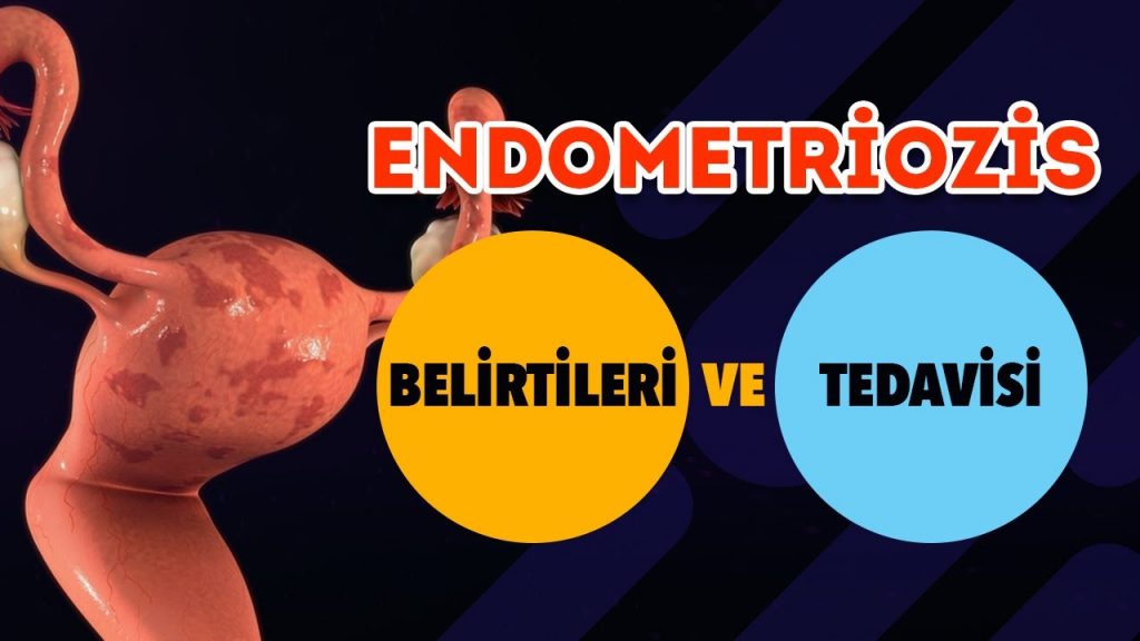 Endometriozis Tedavisi